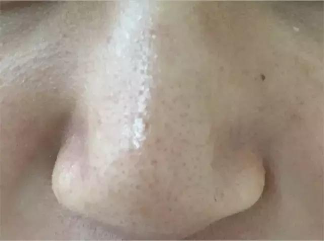 猪鼻贴去黑头,泰国进口去黑头鼻贴