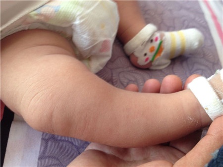 新生儿小腿弯怎么回事,新生儿小腿很弯是什么原因