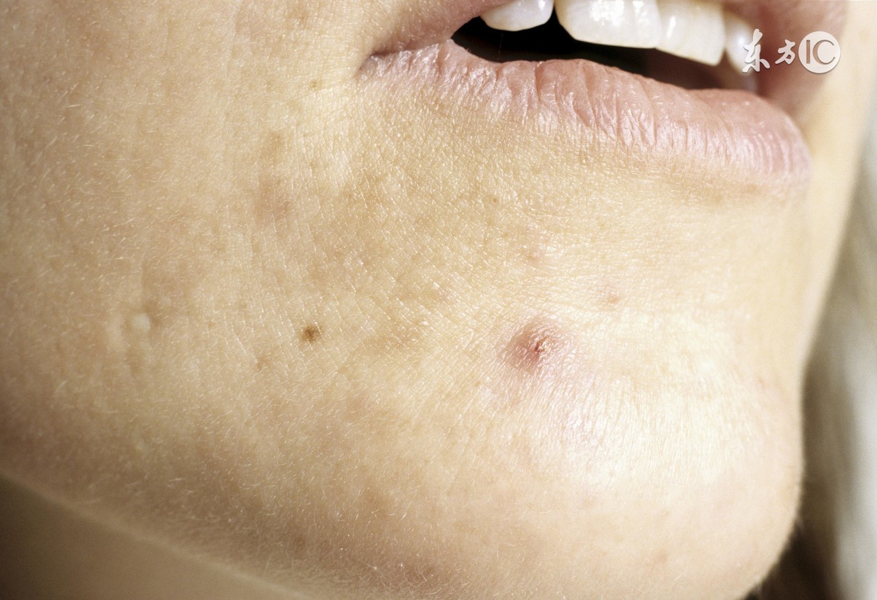 “闭口粉刺”让人不忍直视！关于“粉刺”不得不说的秘密~