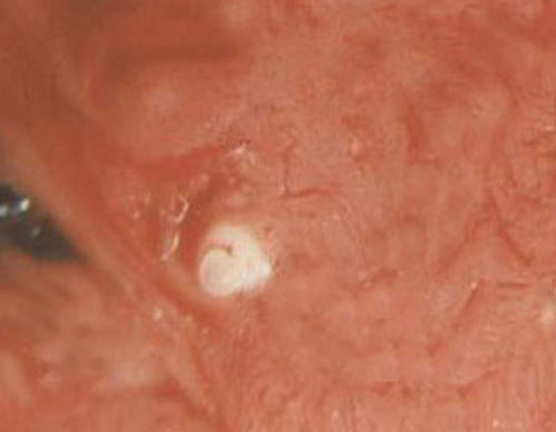 人感染猪囊虫病怎么办,人畜共患寄生虫病中的动物是什么