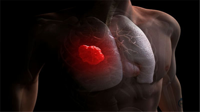 肺癌晚期可以喝转移因子口服液吗,肺癌吃转移因子有效果吗