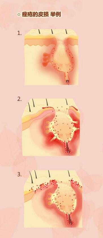 真正的痘印是可以祛的吗,暗紫色痘印是红痘印还是黑痘印