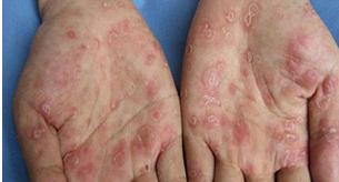 梅毒检查TPPA或TPHA阳性是啥意思