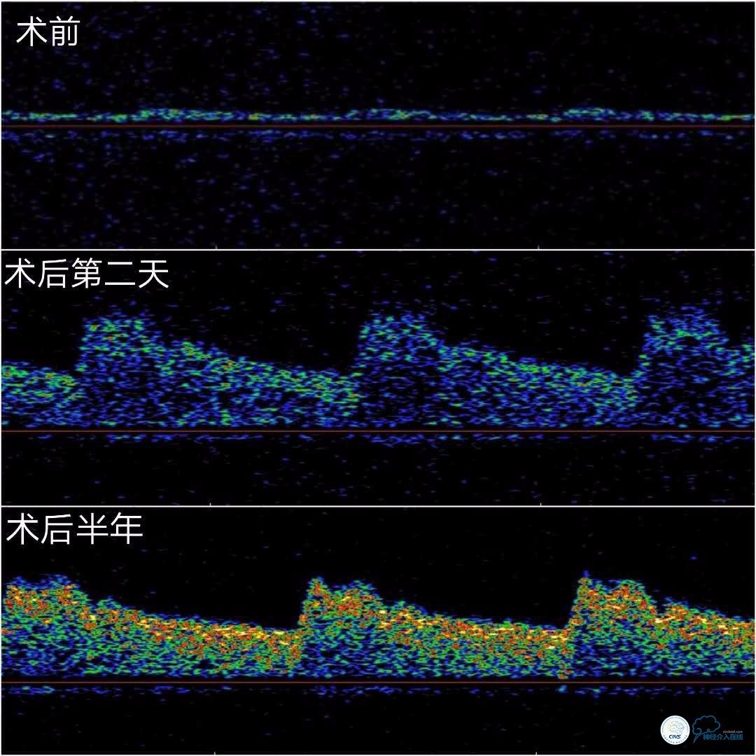 右侧大脑后动脉p1段狭窄支架手术,天坛周记