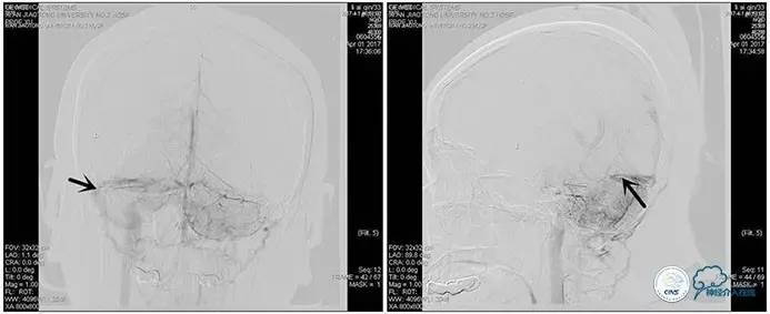 脑静脉窦狭窄做支架危险吗,静脉窦狭窄做支架后多久恢复