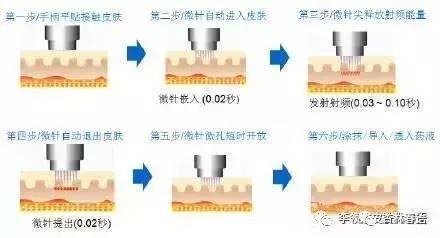 腋臭治疗黄金微针和微创手术对比,黄金微针微创腋臭手术能根治吗