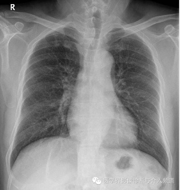 咳嗽排除了肺部的问题,咳嗽为什么比不咳好