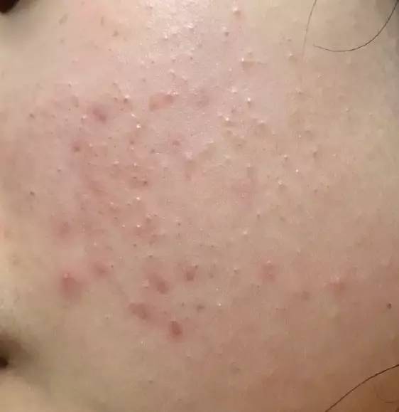 战痘大结局完整版,战痘合集完整版