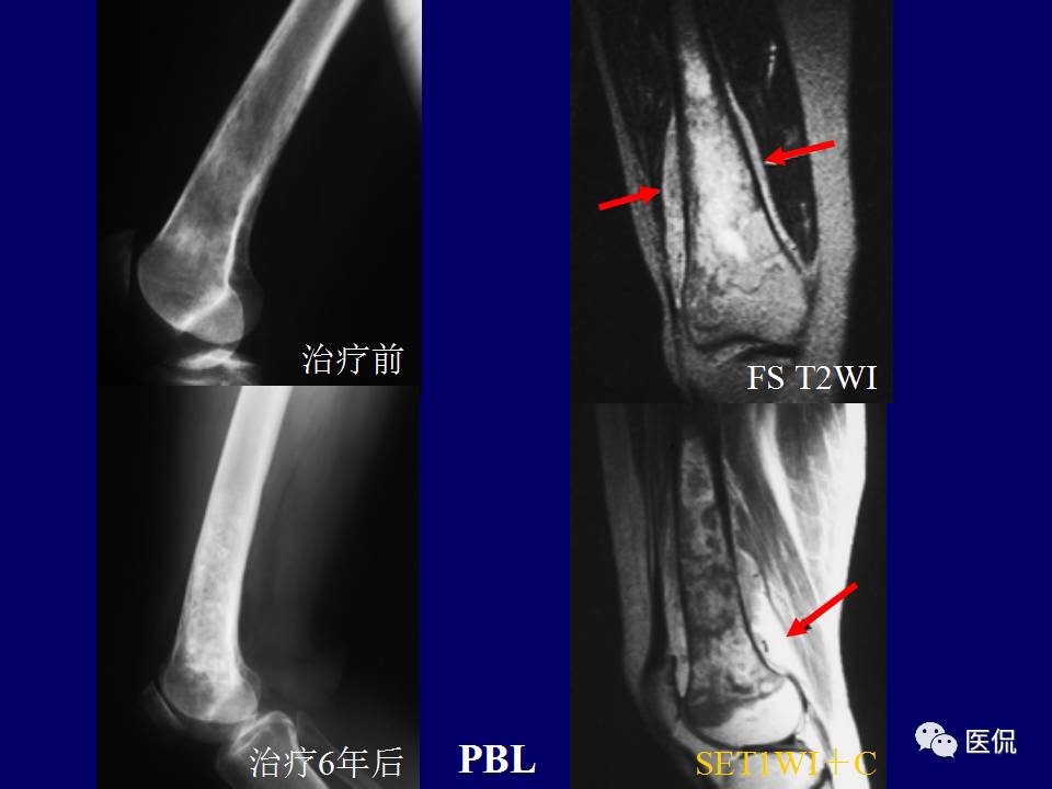 徐文坚老师精讲：原发性骨淋巴瘤影像学诊断医学影像精品PPT