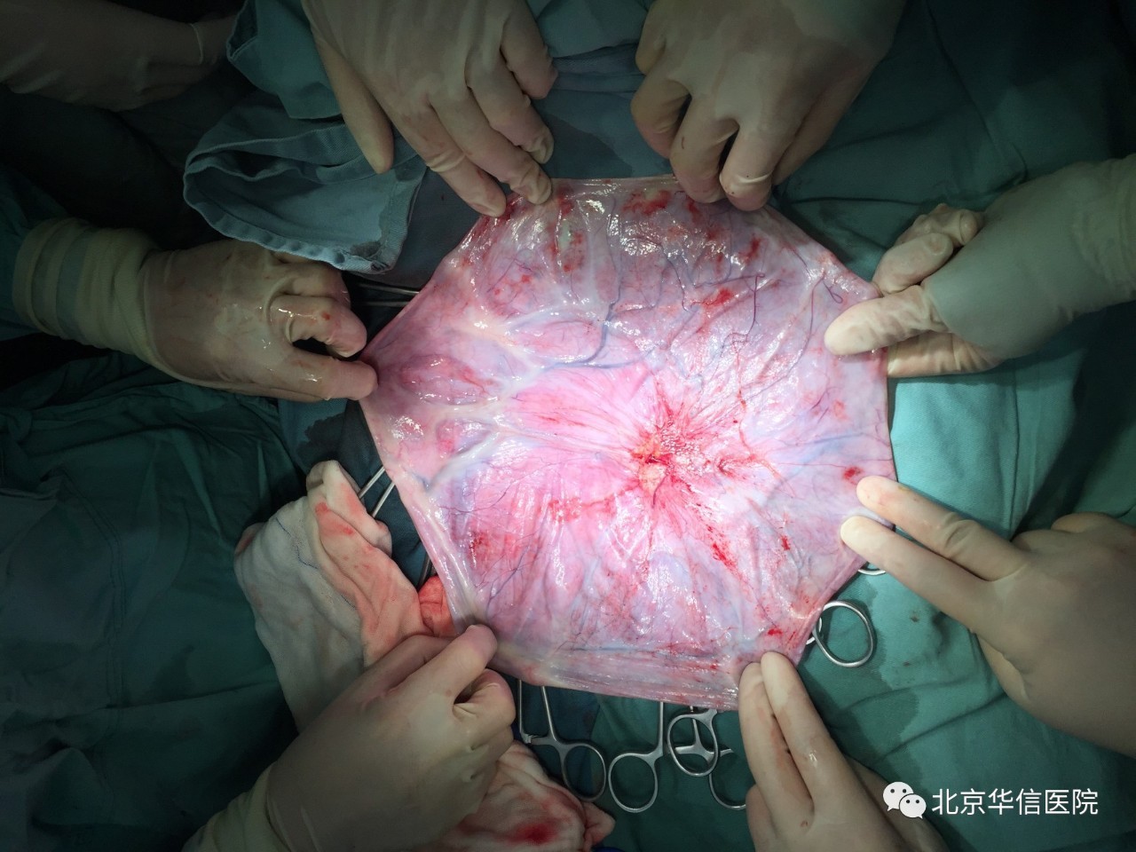 附件囊肿10厘米手术,附件囊肿切除术手术记录