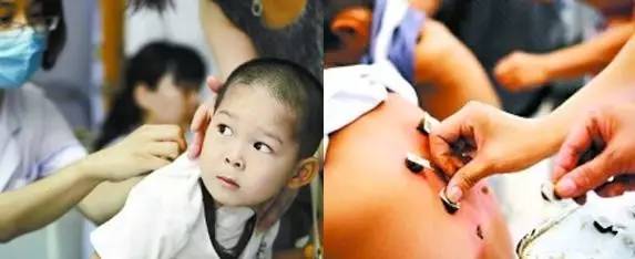 三伏贴能自制吗?孩子能贴吗?选择哪些穴位贴?贵医附院专家为你详细解答