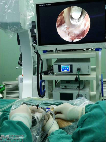 绵阳科学城医院腰间盘突出手术,绵阳腰椎间盘突出手术