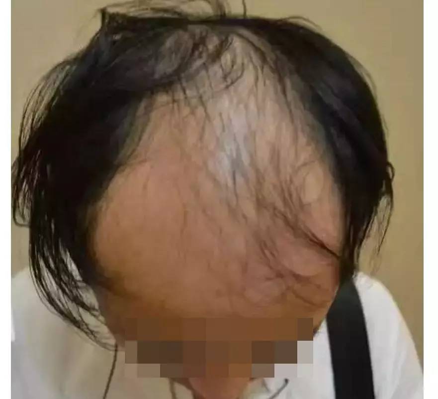 严重脱发秃顶发际线后移如何改善,长期熬夜导致发际线后移秃顶脱发