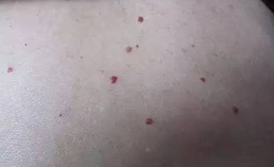 皮肤长红痣得了肝病医生先别慌,身体长红痣肝病的早期症状有哪些