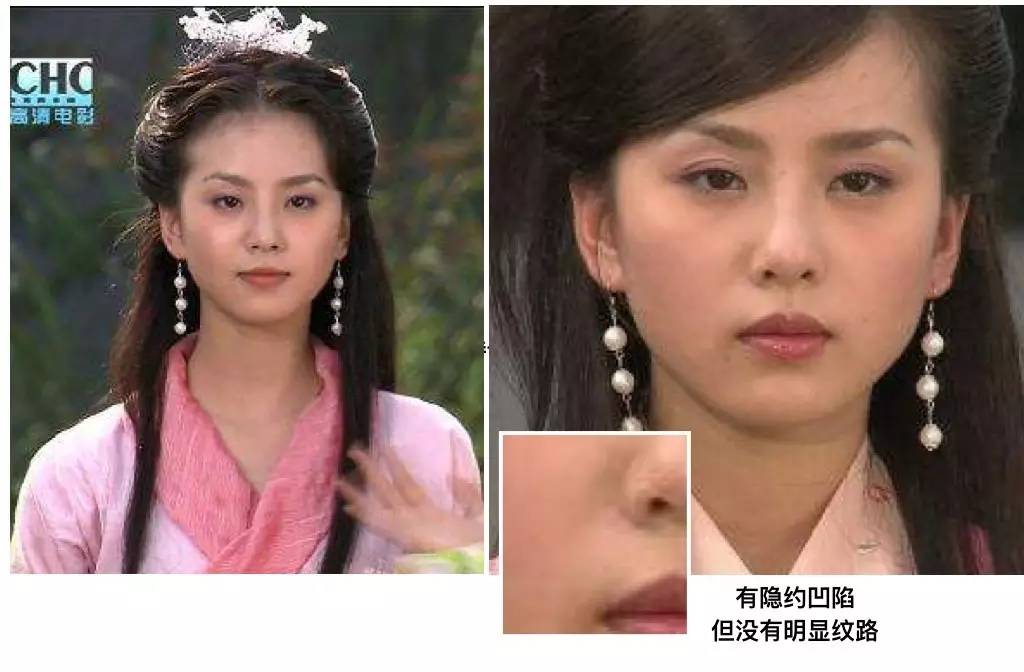 泪沟法令纹颈纹显老怎么办,改善泪沟法令纹全脸提升的方法