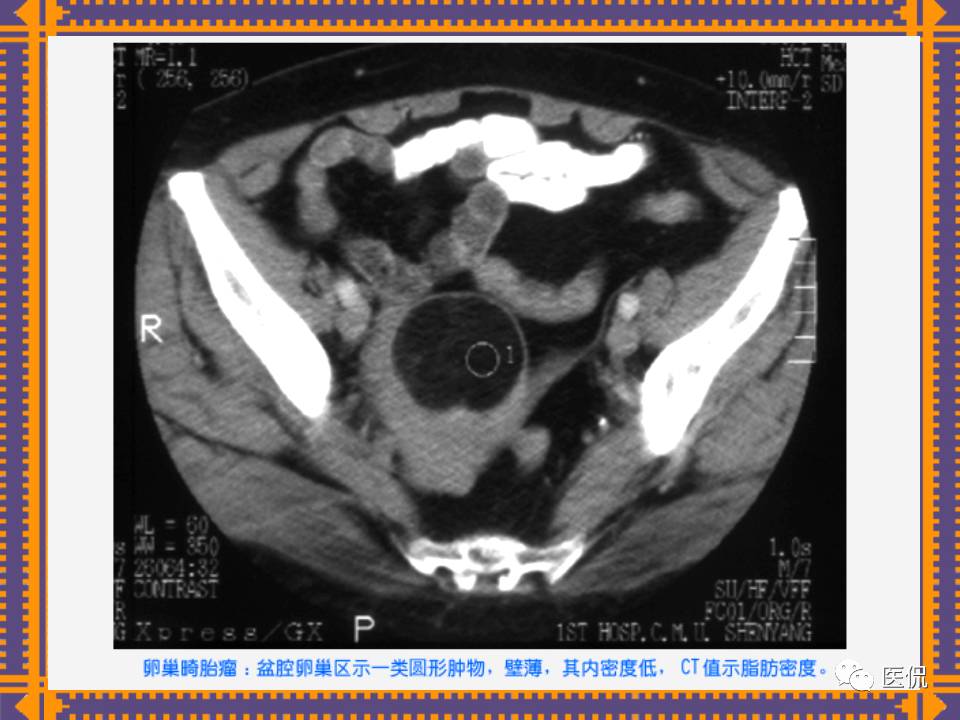 生殖系统疾病影像学诊断医学影像精品PPT
