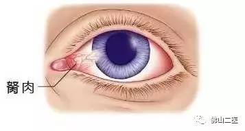 眼皮表面上长的赘生物,眼上的赘生物是什么