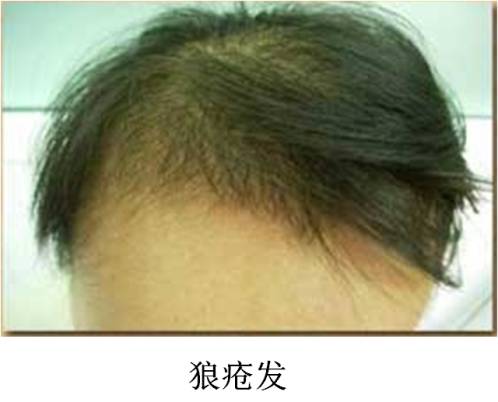 爸妈说你“二天”一定要得的这种病，到底是个啥子病？