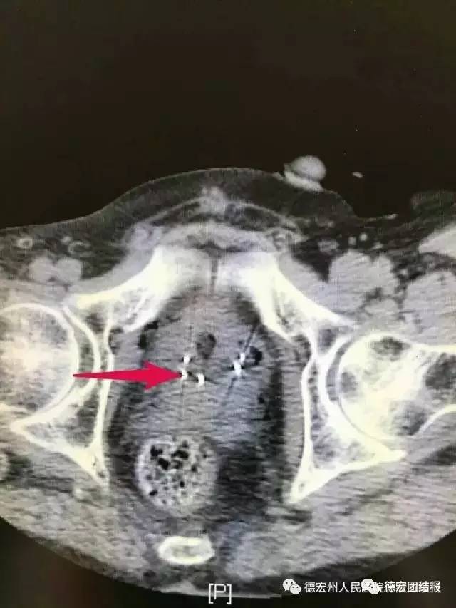 云南德宏中草药治癌,云南肿瘤医院治疗癌症