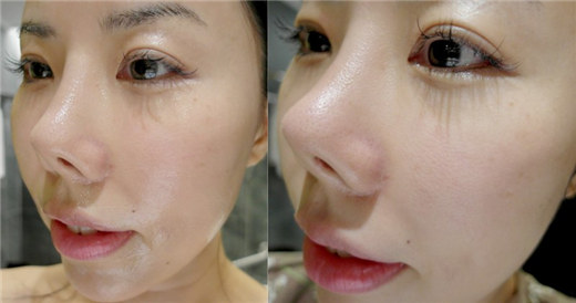 台湾网红仆街狗吃屎硅胶往内插1年后惊变朝天鼻