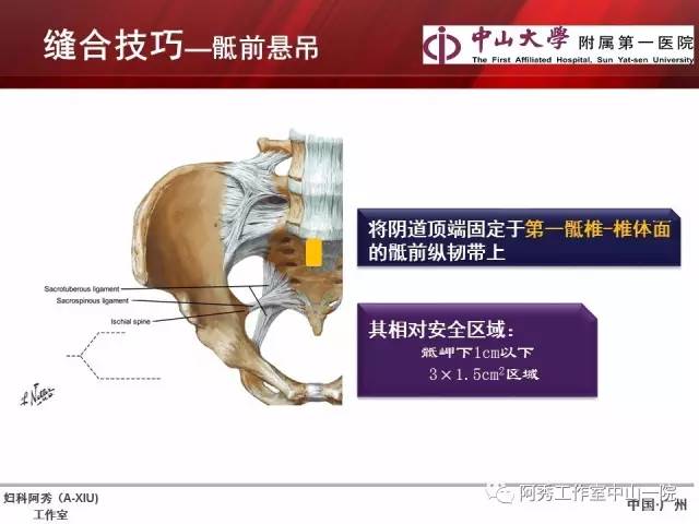 妇科腹腔镜下常用缝合技巧
