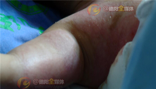 19岁烧伤女孩小玲出院啦,烧伤女孩小玲最新消息