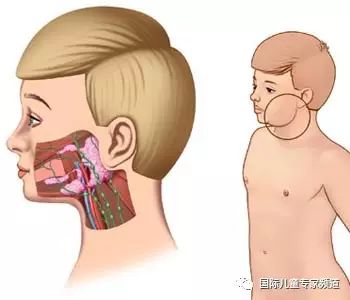 腮帮子肿与扁桃体肿有关吗,腮帮子肿了是痄腮吗
