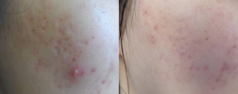 激光祛闭口痘痘,闭口粉刺可以做激光祛痘吗