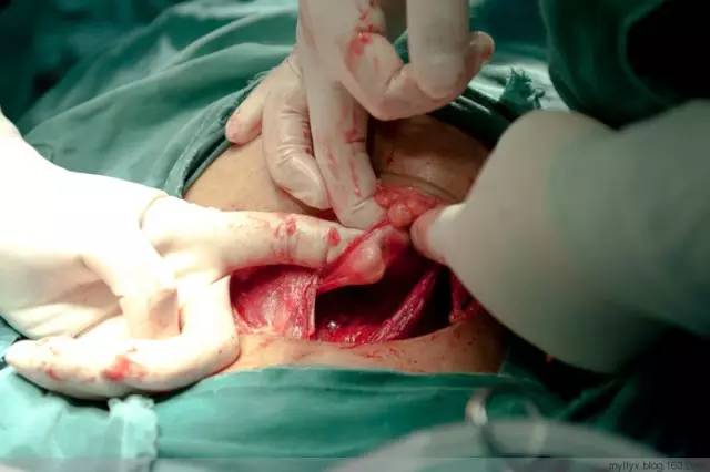 剖腹产全景记录,剖腹产恢复不同时期的照片