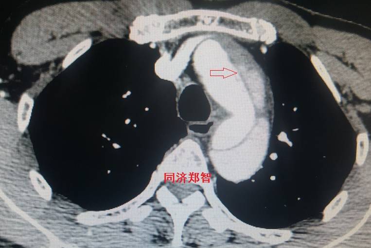 急性主动脉夹层cta影像诊断与鉴别,冠状动脉cta可以看到主动脉夹层吗