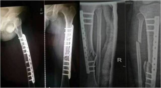 骨折复位后局部断端成角,骨折断端稍错位能恢复吗