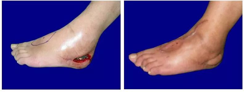 身上伤口不易愈合是怎么回事,身体后面有伤口一直不愈合