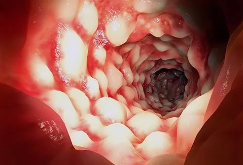 免疫系统出了问题是什么病,免疫系统出了问题会得什么病