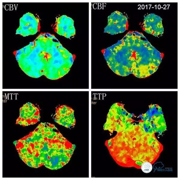 天坛医院脑血管狭窄手术做得好吗,天坛医院动脉狭窄介入手术费用