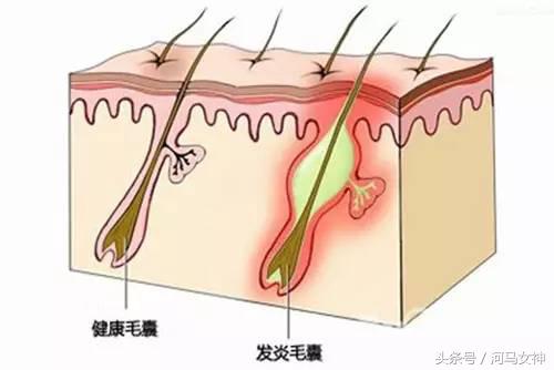 抗痘填坑,抗痘期间忌口大全