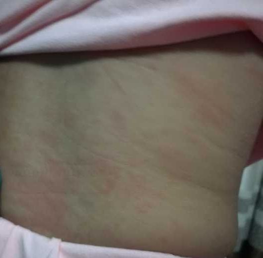 9个月宝宝幼儿急疹全程实录：3天40度高烧不退，48小时出疹24小时消疹，应对及护理我是这样做的