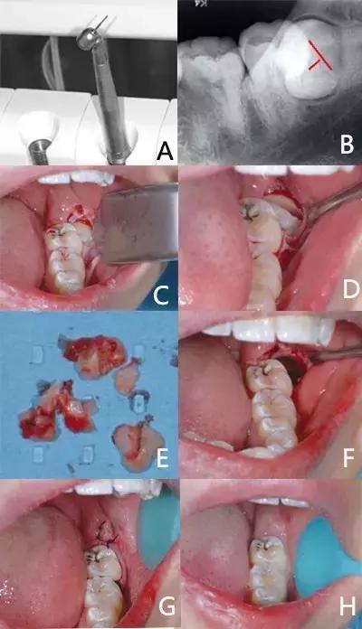 微创阻生齿拔除需要多久,微创复杂牙拔除术阻生智齿