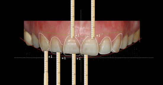 拯救四环素牙,四环素牙的完美蜕变过程