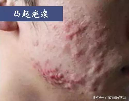 十几年痘坑痘印怎么祛除,十几年的水痘坑怎么填平