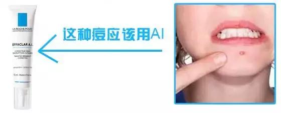 痘痘闭口痘印黑头,痘痘闭口毛孔粗大修复