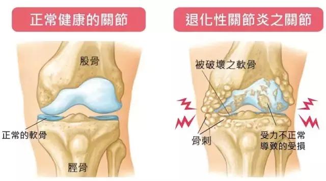 长了骨刺自己慢慢会自愈吗,脚跟长骨刺会引起哪些症状