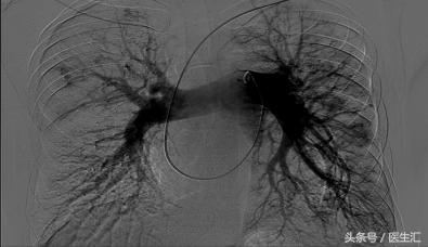 大量咯血突然停止见于什么病,间断性咯血是什么原因