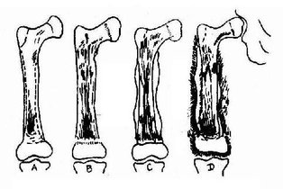 慢性死骨取出术知多少?