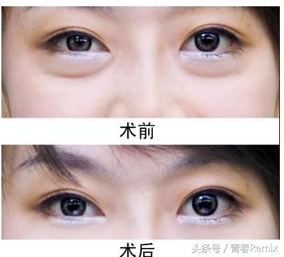 卧蚕要不要修,卧蚕要不要化高光