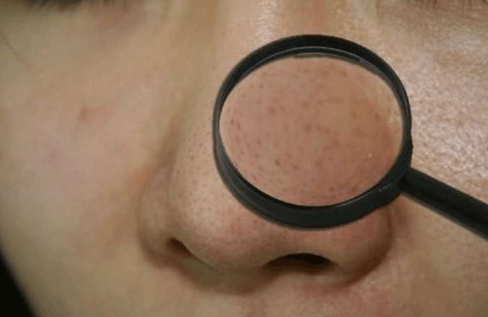 挤鼻头导致毛孔变大怎么恢复,皮肤管理皮肤粗糙毛孔粗大改善