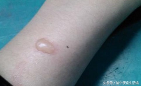 生活中烫伤抹什么,生活小妙招烫伤