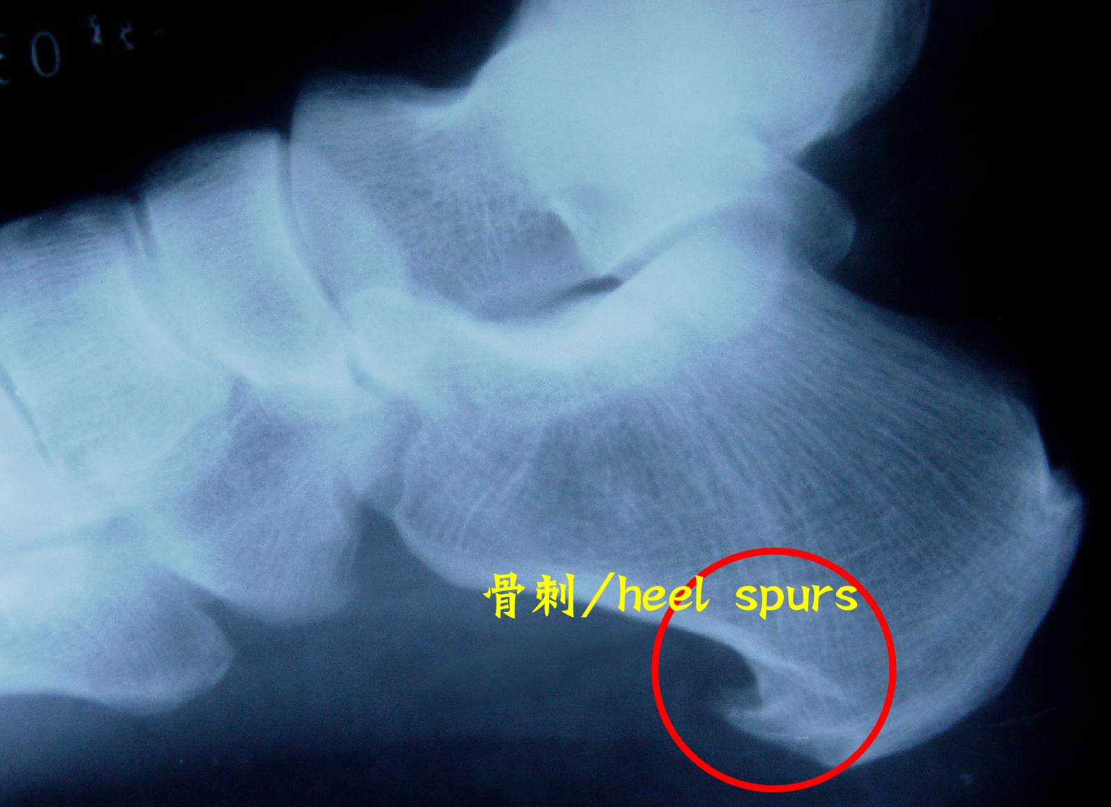 疑问医答：脚后跟长骨刺怎么办？“骨刺”是越磨就会越好的吗？