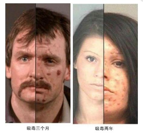 吸毒掉头发吗,吸毒掉头发是怎么回事