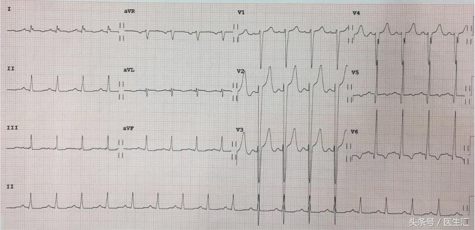 喝白酒后呼吸困难怎么回事,喝啤酒呼吸困难怎么回事
