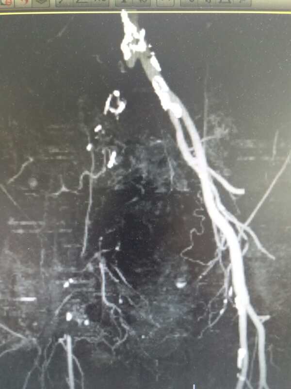 治下肢血栓闭塞脉管炎中药方,下肢动脉慢性血栓闭塞